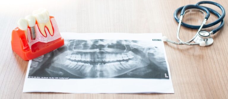 dental implant model in dental office CVY744K