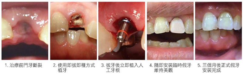 implantcase2