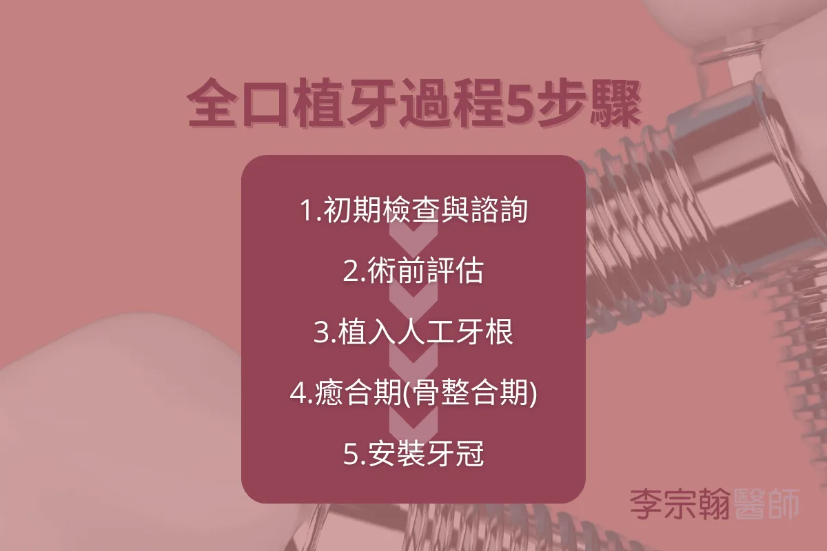 全口植牙全解析:適合對象、治療流程與優缺點全面剖析 3 全口植牙過程是怎麼進行的?